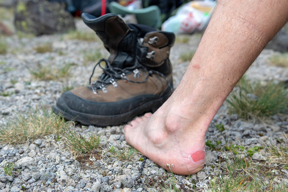 Blisters and Effective Care Tips for Hikers